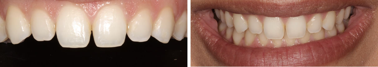 Composite Bonding #1 - Before