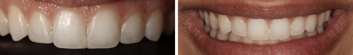 Composite Bonding #1 - After