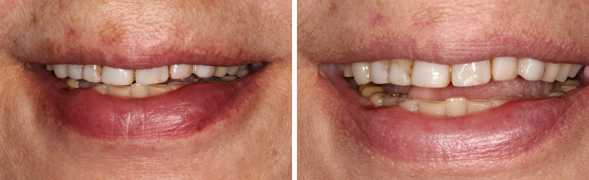 Composite Bonding #2 - Before