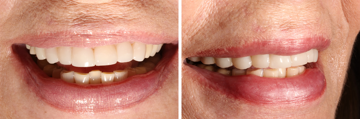 Composite Bonding #2 - After