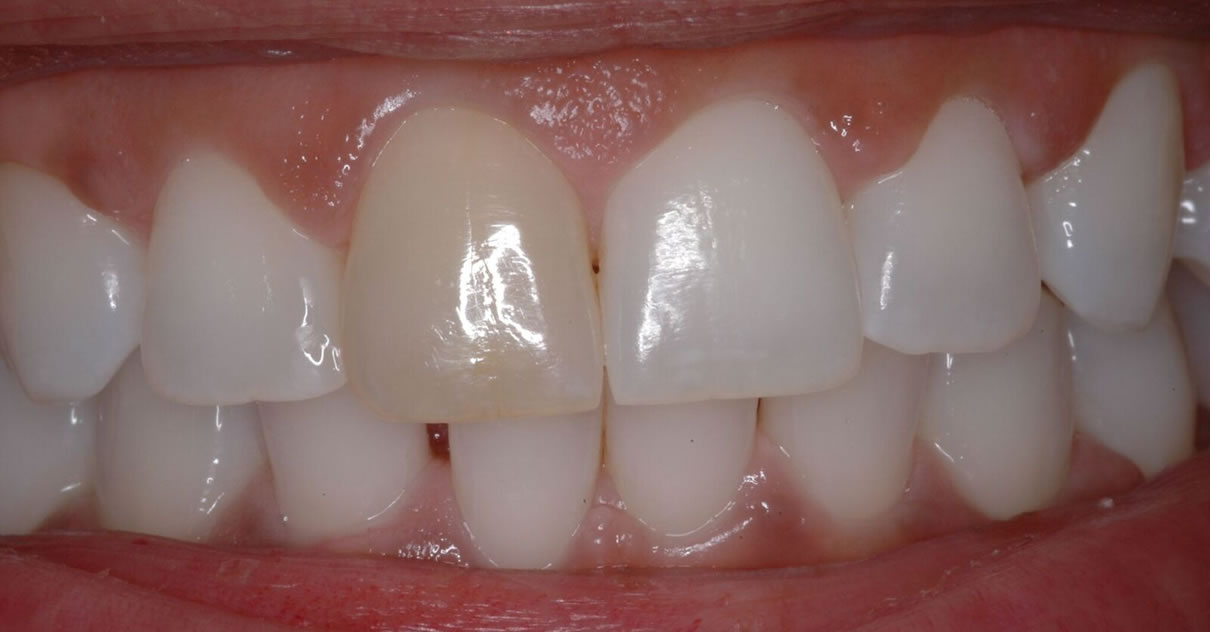 Composite Bonding #3 - Before