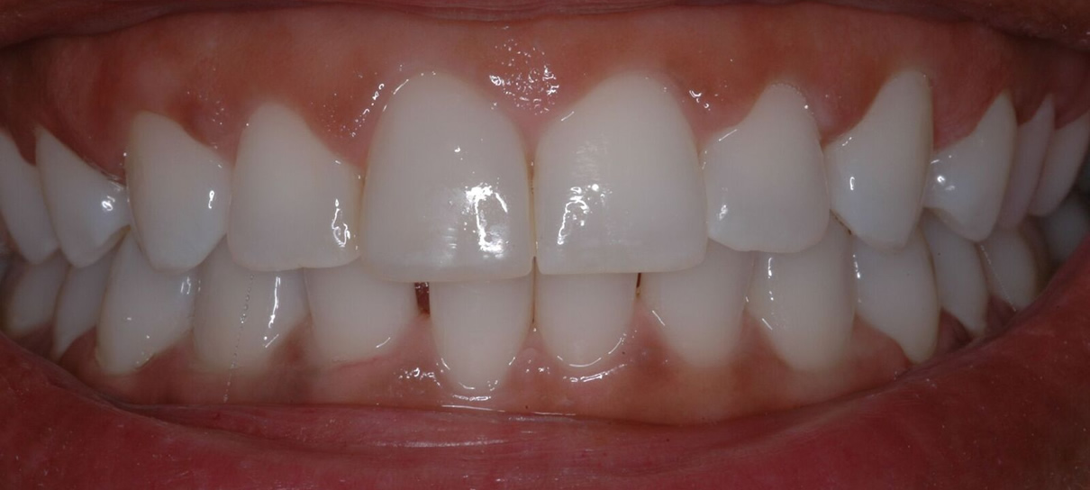 Composite Bonding #3 - After