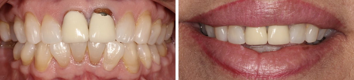 Minimally Invasive Esthetic Improvement #2 - Before