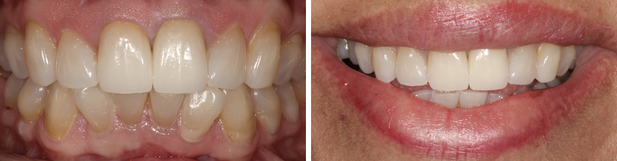 Minimally Invasive Esthetic Improvement #2 - After