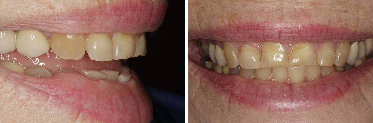 Complex Rehabilitation Case #1 - Before