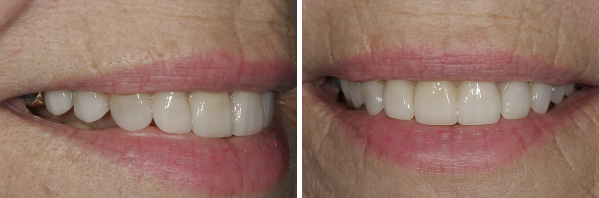 Complex Rehabilitation Case #1 - After