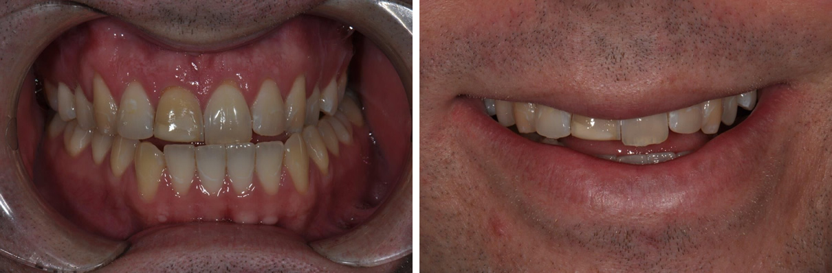 Minimally Invasive Esthetic Improvement #1 - Before