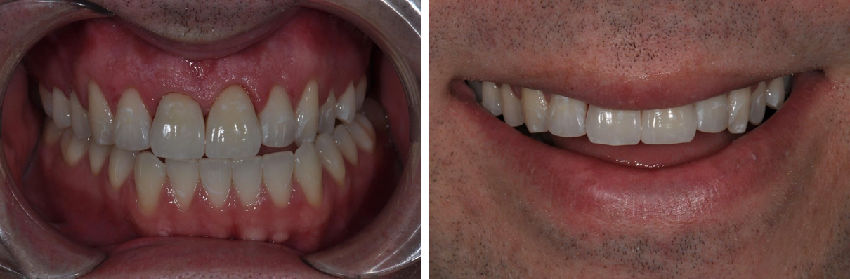 Minimally Invasive Esthetic Improvement #1 - After