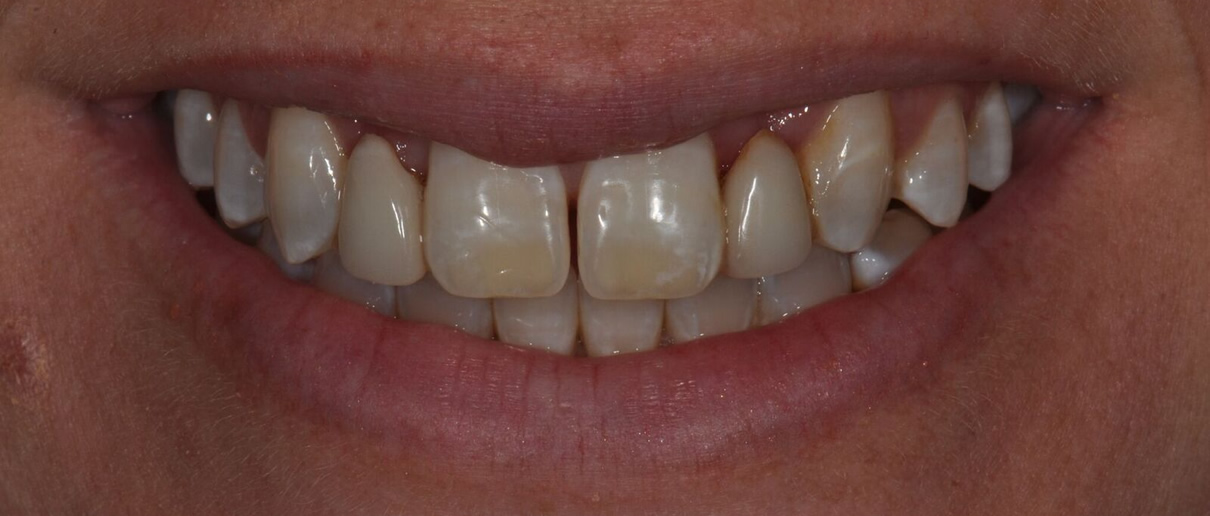 Minimally Invasive Esthetic Improvement #3 - Before