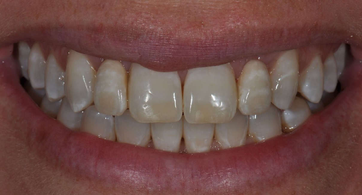Minimally Invasive Esthetic Improvement #3 - After