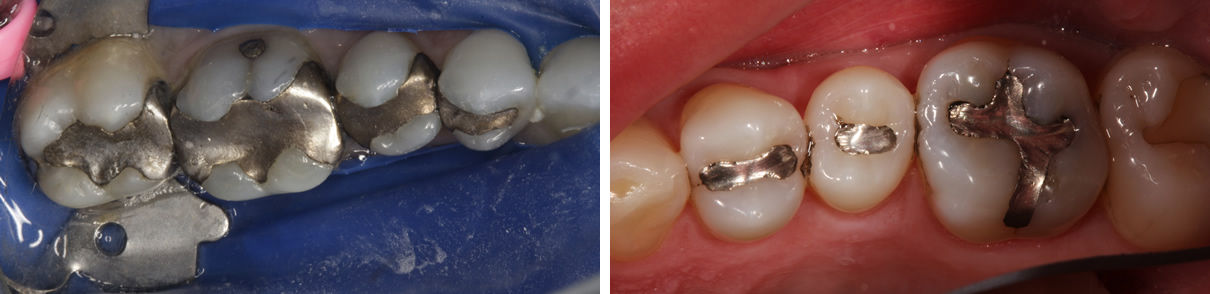 Posterior Crowns and Fillings - Before