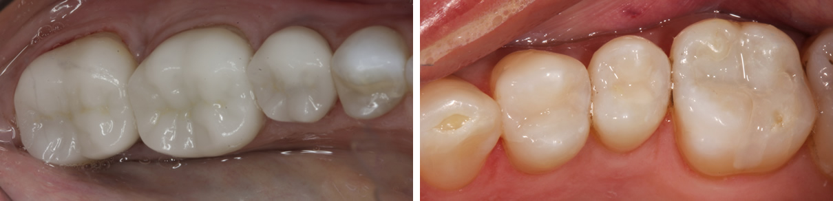 Posterior Crowns and Fillings - After